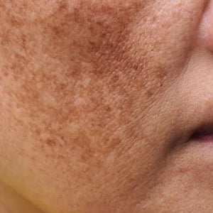 Dark spots