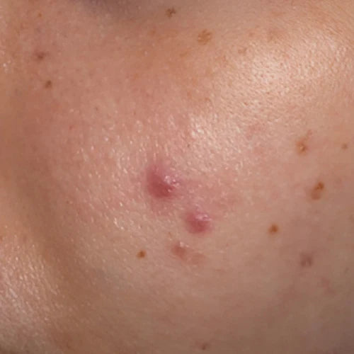 Acne