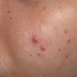Acne
